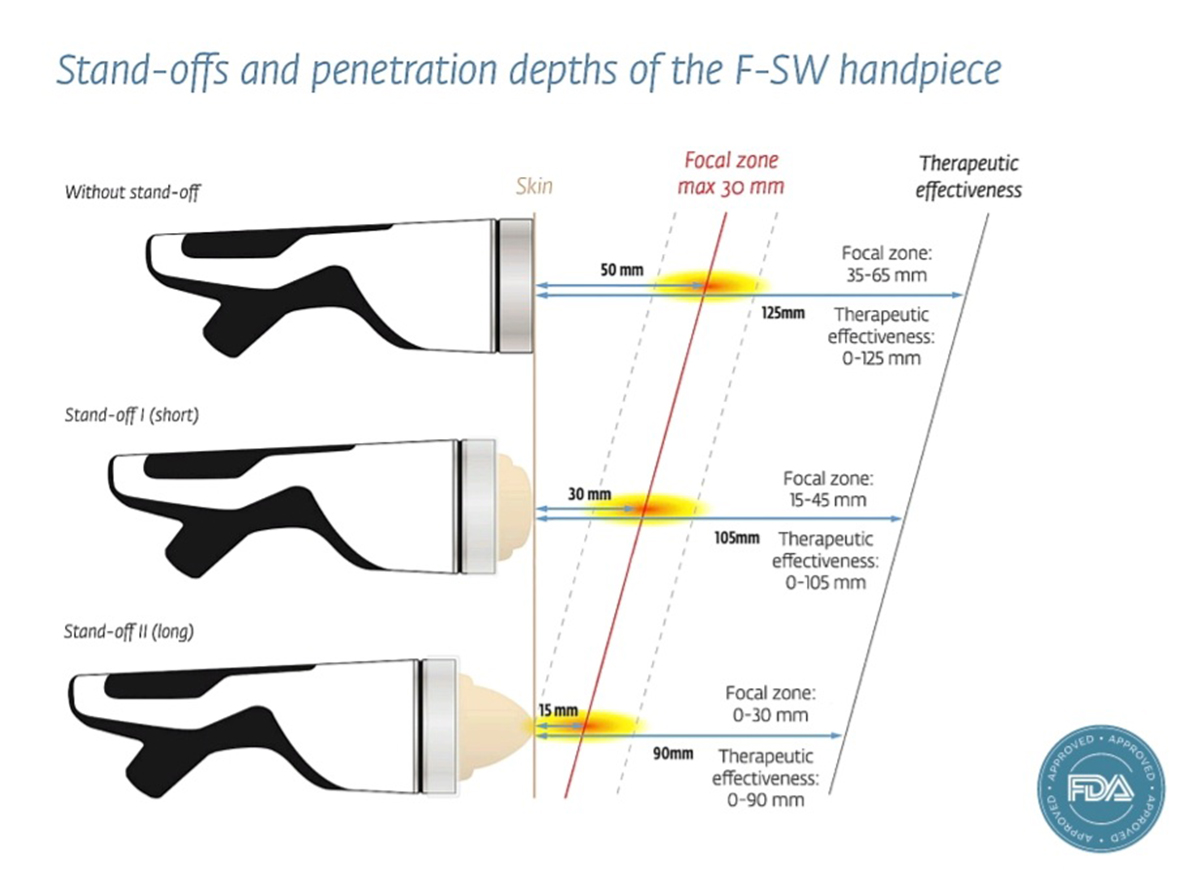 브이친 특허기술