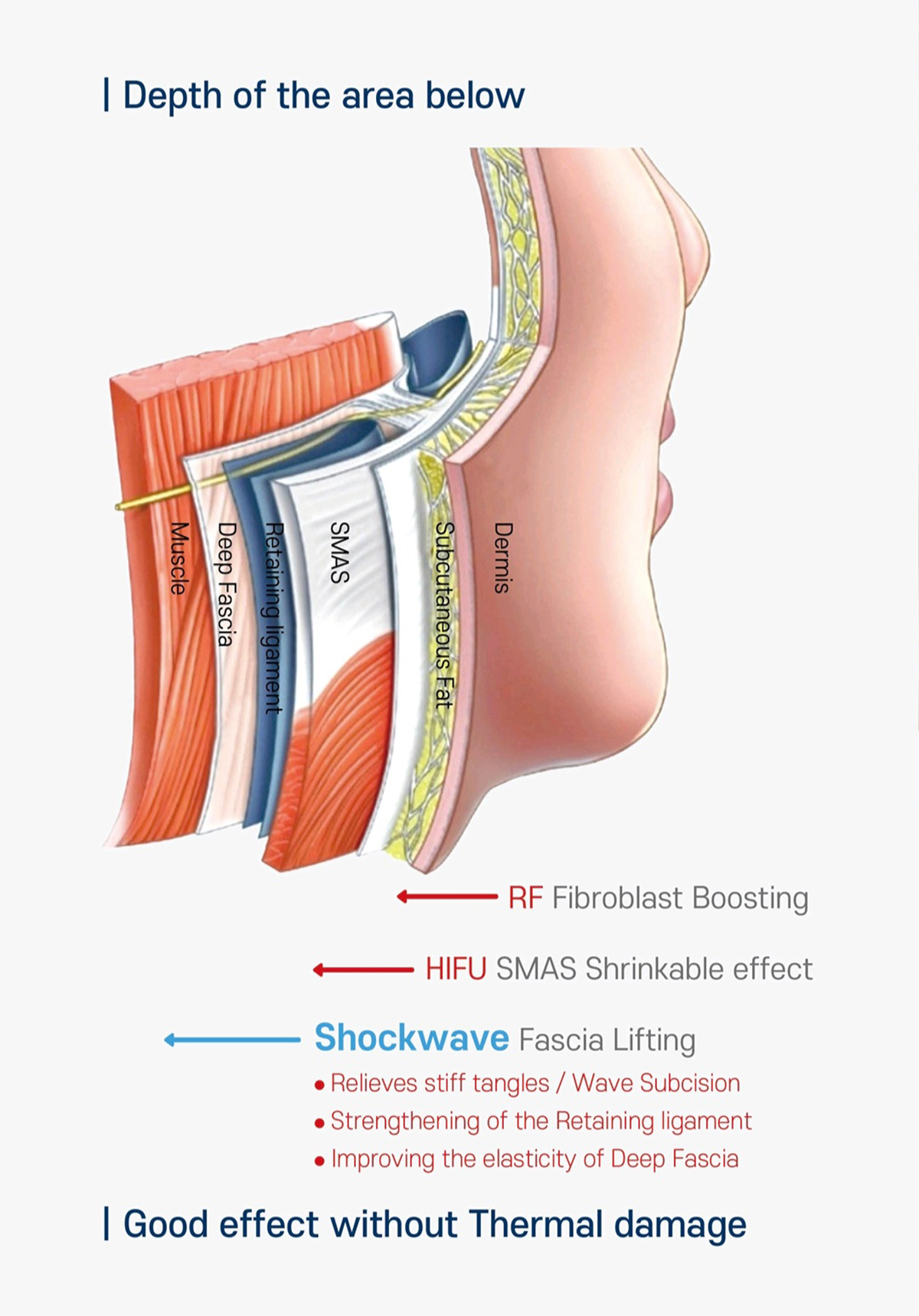 브이친 특허기술