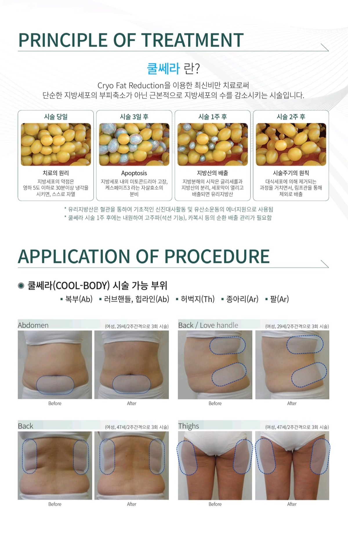 비만치료기 쿨쎄라